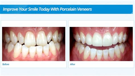 porcelain veneers in burnsville mn